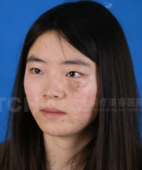 "【时光公益救助】为了祛除脸上的胎记,她病急乱投医险毁容"