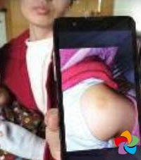 "3岁女儿屁股上有针眼?孩子:老师用针打\""