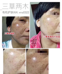 "怎样可以快速祛斑?专业祛斑老师帮你解答"