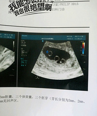 ͬ������̥��Ҫ��Ҫ��̥����