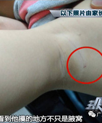 "3岁孩子身上满是疑似针眼,一见幼儿园老师就躲……园方回应让家