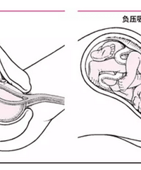 "人流真的像广告上说的那么轻松?那可能是个噩梦"