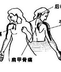 "七类颈椎病,快来测测你是哪一种!"