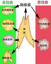 化疗在胸腺瘤治疗中不可替代的作用