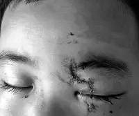 5岁男童幼儿园午睡,突然眼球破裂!得知原因,家长懵了