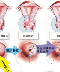 "宫颈涂片检查多少钱?做涂片检查有哪些注意事项?"