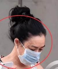 钟丽缇旧照曝光 额头脖子布满“密麻圆点”