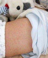 "幼儿急疹一定是高烧?出过就终生免疫?不一"