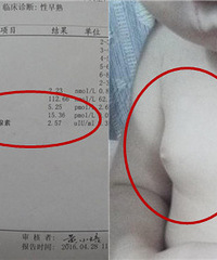 18个月宝宝的双乳,这是性早熟吗?