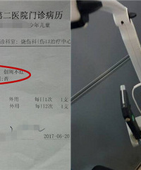 我娃被仪器烧伤,浙医二院却在推卸责任