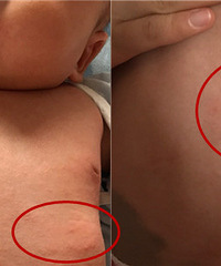 一吃母乳就发湿疹,我已忌口了该怎么办
