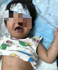 "2岁宝宝40℃高热反复不退,眼睛红得像兔子,屁股上还起了皮!"