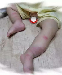"孩子被蚊虫叮咬,儿科医生教你正确做法!"