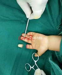 浙江一妈妈带18个月宝宝去工厂上班结果宝宝手指被切了一节