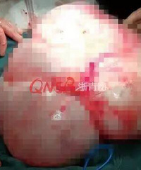 "杭州一女子腹围达到138厘米,做完手术一"