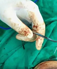 "这…是什么操作?产妇急性乳腺炎,催乳师竟"