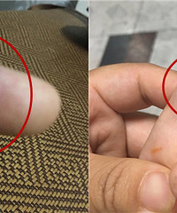这是啥?说擦5天药就消掉,现在却大了