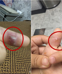 宝宝手上这是啥?一个礼拜反而更大了!