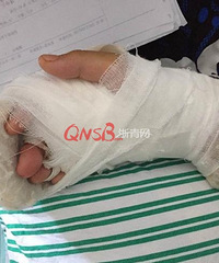 心疼!杭州10岁女孩切西瓜菜刀掉落 两根手指啊