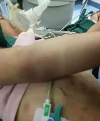 ����3��Ůͯ�����Ű����­�ڳ�Ѫ����������