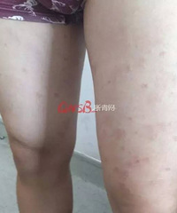 "杭州一大学女教师胸颈部反复发红疹子,竟然是得了和林心如一样的