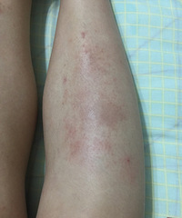 皮肤搔痒