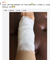 "胡静崴伤脚自侃似猪蹄 医嘱:在家猥琐发育别浪"