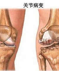 "关于骨质增生,你踩过的那些坑"