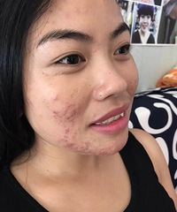"健康的减肥连痘痘都治好了,前后照对比,是不是换了一张脸?"