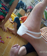 治疗骨质增生