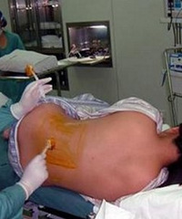 "剖腹产后一个多月刀疤突然崩裂大出血,竟是这个原因!"