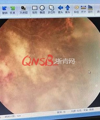 "浙江一中年男子半年来视力持续下降,到医院一看竟然查出艾滋病!