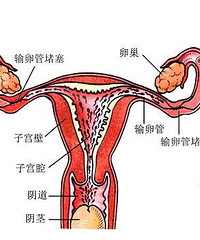 "输卵管堵塞怎么办 在治疗的同时需要注意什么呢"