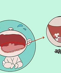 "什么是鹅口疮 鹅口疮怎么预防呢"