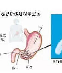 "有癌变风险?准丈母娘强行拆散恋人!只因小伙婚前查出……大多数