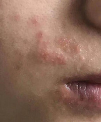 脸上小范围的长湿疹怎么办,求问各位有什么好方法治疗!