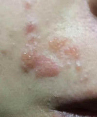 脸上小范围的长湿疹怎么办,求问各位有什么好方法治疗!