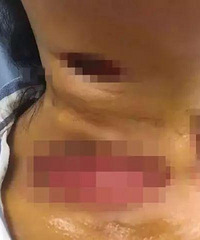 "40岁女子感染“食肉菌” 颈部被“吃”出个大洞"