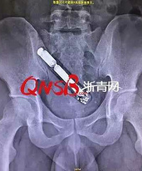 "浙江一小伙直肠被异物堵了12个小时,医生说幸好来得及时!"
