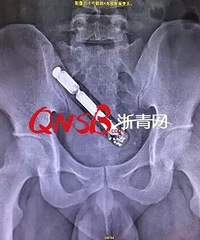"浙江一小伙直肠被异物堵了12个小时,医生"