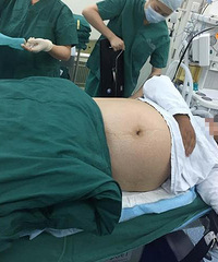 "绍兴一孕妇体重240斤 生娃时手术床都不够宽"