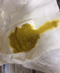 "是否是过敏性腹泻,还能实现全母乳吗?"
