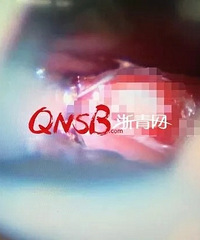 "浙江一女大学生半年多不来月经,医生从她鼻"
