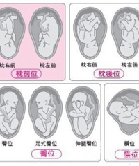 "胎位不正,实现顺产~"