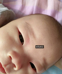 "婴儿眼皮湿疹"