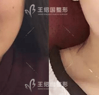 生长因子注射在皮下的危害
