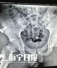 "痛心!海宁16岁男生上体育课跑步…竟导致要复读一年!怎么回事"