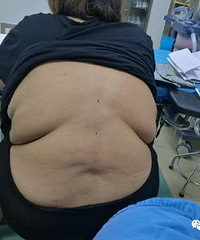 "312斤超重量级孕妇!手术需专人托腹部脂肪,准妈妈一定要注意"
