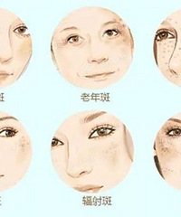 "妊娠斑不能自行恢复怎么办"