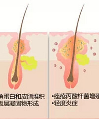 "你应该知道—痘痘的危害有哪些呢"